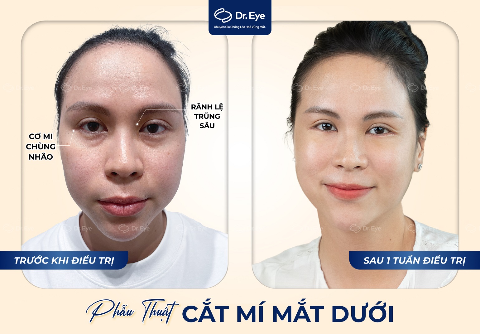 Kết quả cắt mí mắt tại Dr. Eye – Chị Tăng Kim Yến, nếp mí rõ nét